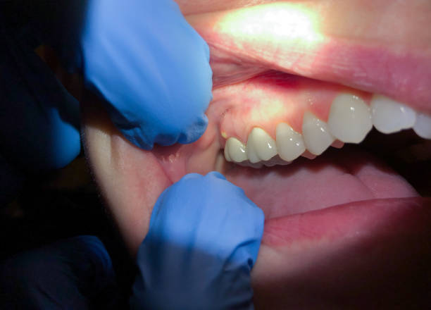 Best Broken or Chipped Tooth Repair in Smithville Sanders, IN